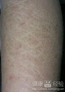 魚鱗皮膚病如何才能根治，全面解析與應(yīng)對(duì)策略，全面解析魚鱗皮膚病根治之道，應(yīng)對(duì)策略大揭秘