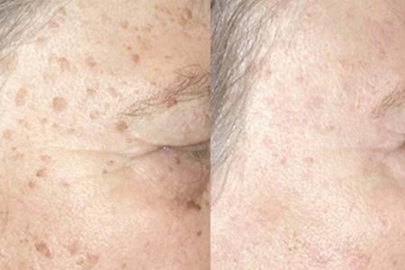 怎樣消除老年斑——全面解析與應(yīng)對(duì)策略，全面解析，消除老年斑的應(yīng)對(duì)策略