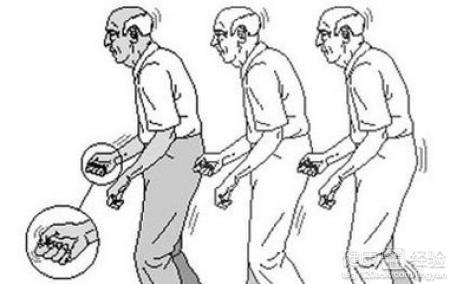 帕金森病的癥狀，深入了解與應(yīng)對(duì)，帕金森病癥狀詳解及應(yīng)對(duì)策略