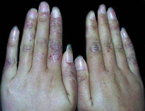 根治凍瘡，預(yù)防復(fù)發(fā)，全面解析凍瘡的治療方法，根治凍瘡，預(yù)防復(fù)發(fā)，全面解析凍瘡治療策略