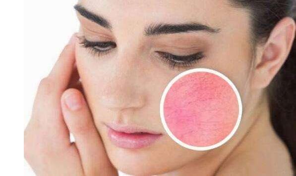 如何有效去除紅血絲，最佳方法與實用建議，紅血絲去除攻略，最佳方法與實用建議