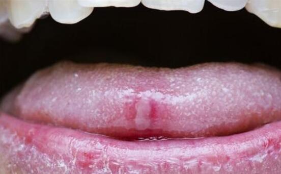 口腔粘膜炎癥，深入了解與治療策略，口腔粘膜炎癥，全面解析與治療指南