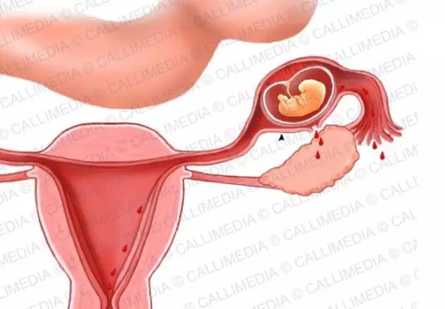 宮外孕20天最明顯的征兆，宮外孕20天的明顯征兆，早期識別與應(yīng)對的關(guān)鍵時(shí)刻