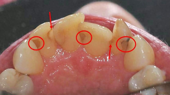 牙結(jié)石怎么去除小竅門，牙結(jié)石去除小妙招分享