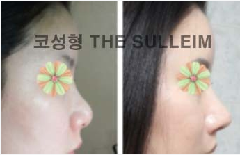 如何縮小鼻翼不手術(shù)，實(shí)用方法與建議，不手術(shù)縮小鼻翼的實(shí)用方法與建議