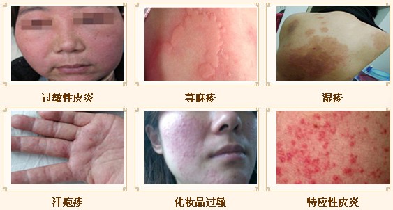 過(guò)敏性皮炎治愈方法，全面解析與應(yīng)對(duì)策略，過(guò)敏性皮炎全面解析，治愈方法與應(yīng)對(duì)策略