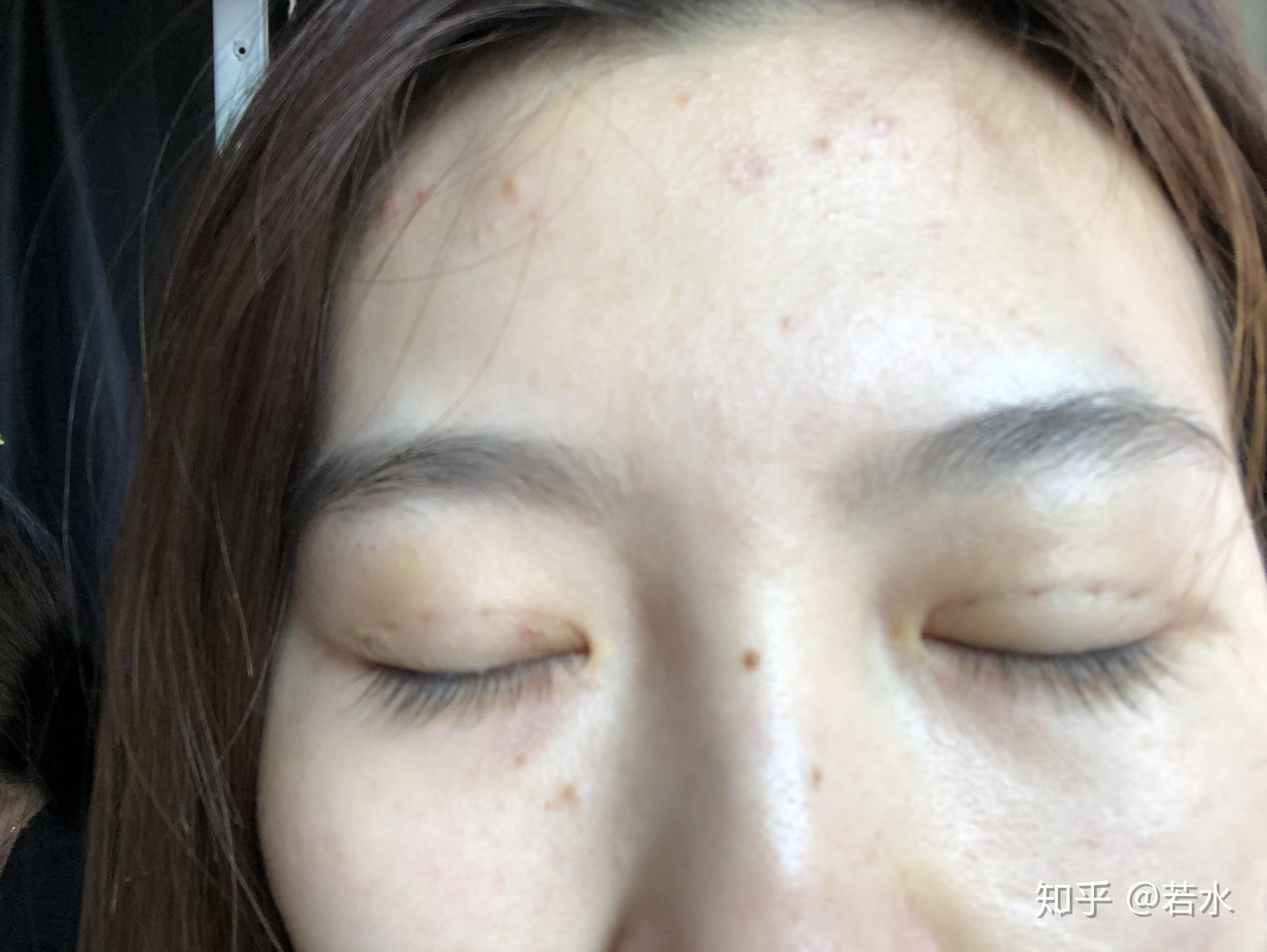 雙眼皮埋線手術(shù)效果持久性解析，持續(xù)時間與影響因素探討，雙眼皮埋線手術(shù)的持久性與影響因素深度解析