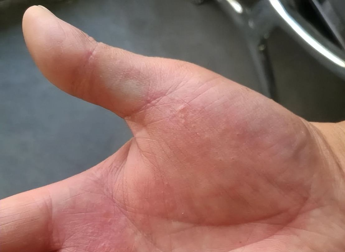 手上起小水泡圖片，原因、治療與預(yù)防，手上起小水泡，圖片詳解、成因、治療與預(yù)防方法