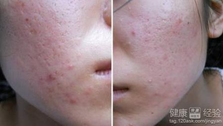 什么是痤瘡？一篇全面的SEO文章解析，全面解析，痤瘡的定義與防治——專業(yè)SEO文章解讀