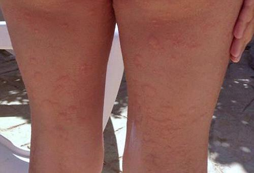 蕁麻疹的治療方法，全方位解析與應(yīng)對策略，全方位解析蕁麻疹治療方法與應(yīng)對策略