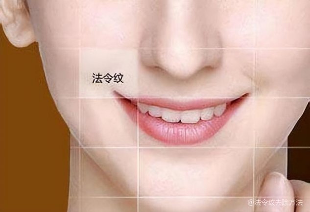 如何去除法令紋——打造青春無痕肌膚，如何消除法令紋，重塑青春無瑕肌膚